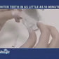 Tooth Whitening System